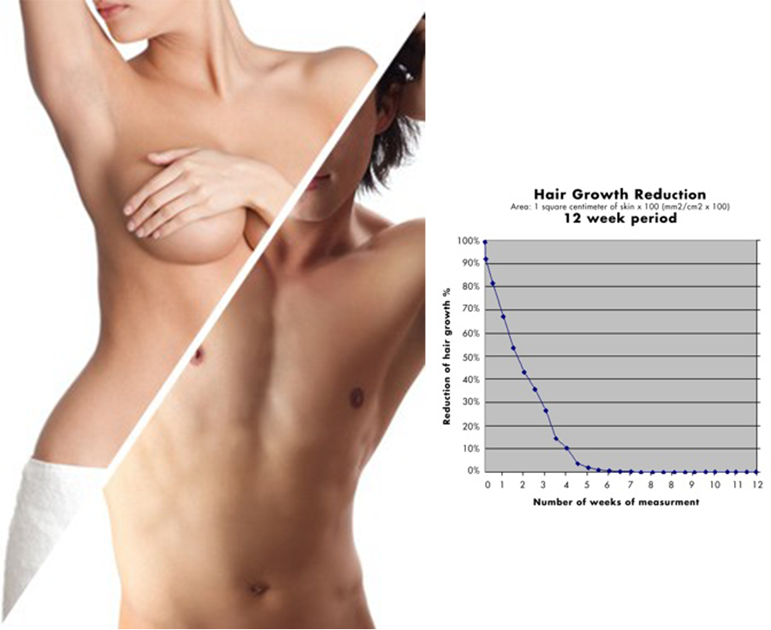 TRANSGENDER HAIR REMOVAL MADE EASY WITH THIS NEW DISCOVERY