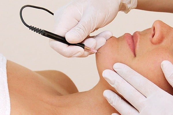 Hair removal at home, we list everything about hair removal