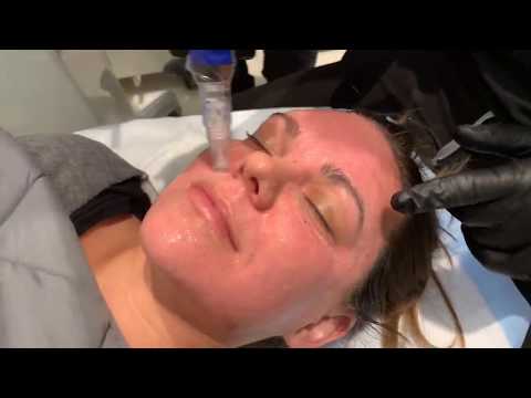 Hollywood Microneedling