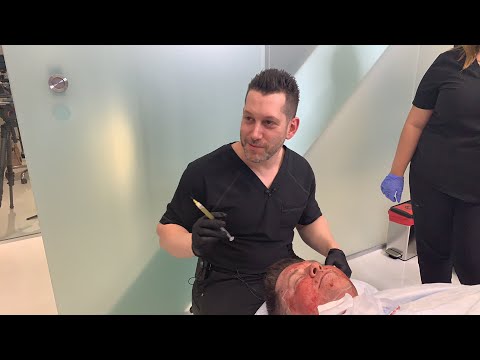 Hollywood Microneedling