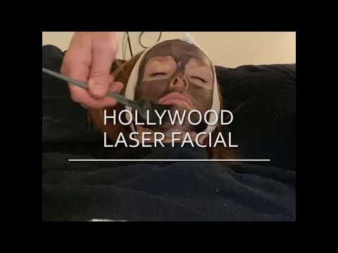 Hollywood Microdermabrasion