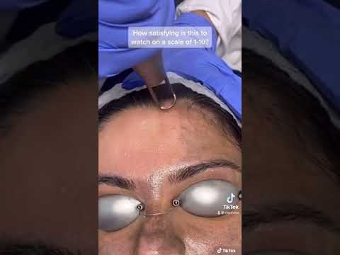 Hollywood Microneedling