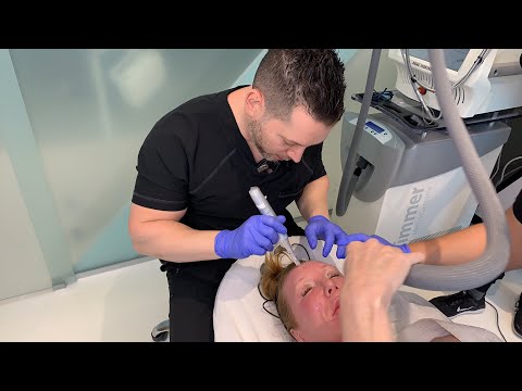 Hollywood Microneedling