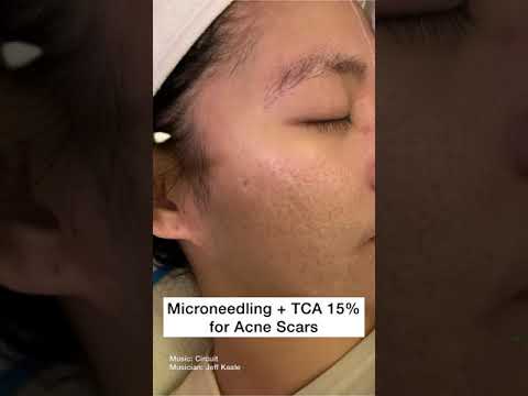 Hollywood Microneedling