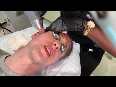 Hollywood Microdermabrasion