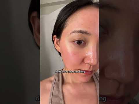 Hollywood Microdermabrasion