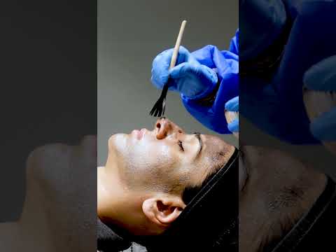 Hollywood Microneedling