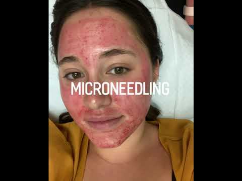 Hollywood Microneedling