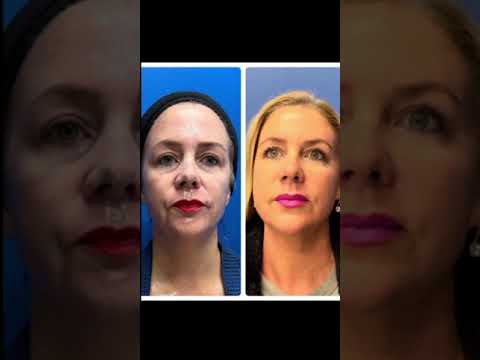 Hollywood Microneedling