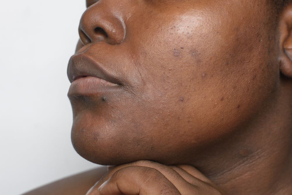 Hyperpigmentation 101