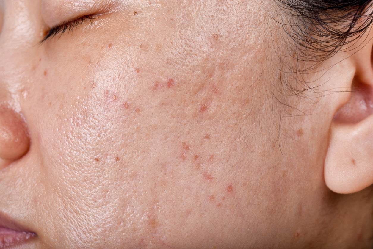EXCLUSIVE: This New TGA-Registered Cream Is Aiding the Post-treatment Healing Process. Here’s What Sets It Apart