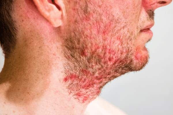 Folliculitis