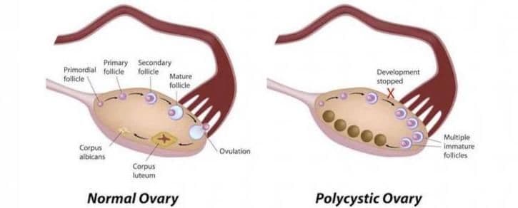 What Is Polycystic Ovary Syndrome (PCOS)?