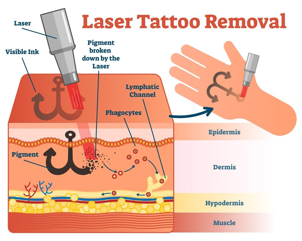 laser tattoo removal vector illustration diagram