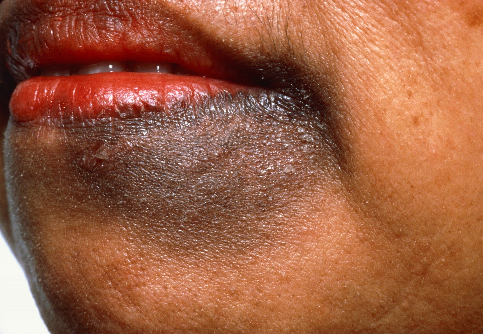 liver spot near mouth