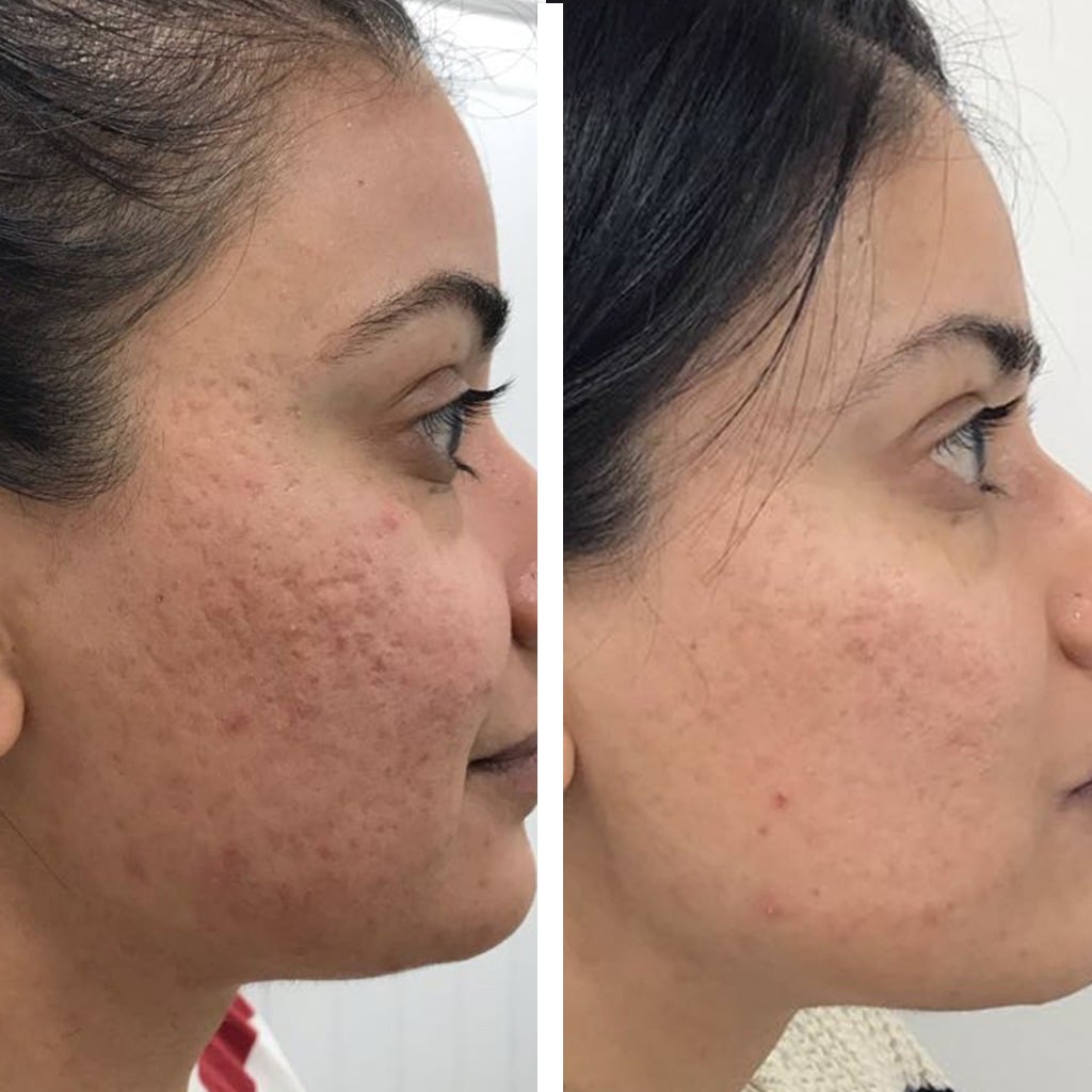 microneedling raleigh nc