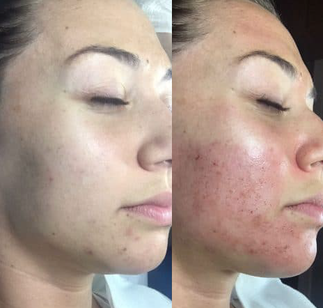 Microneedling Raleigh NC