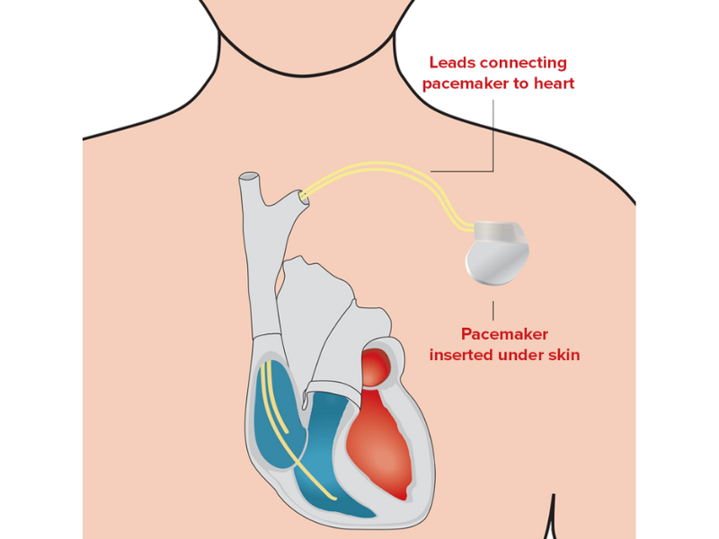 Pacemakers