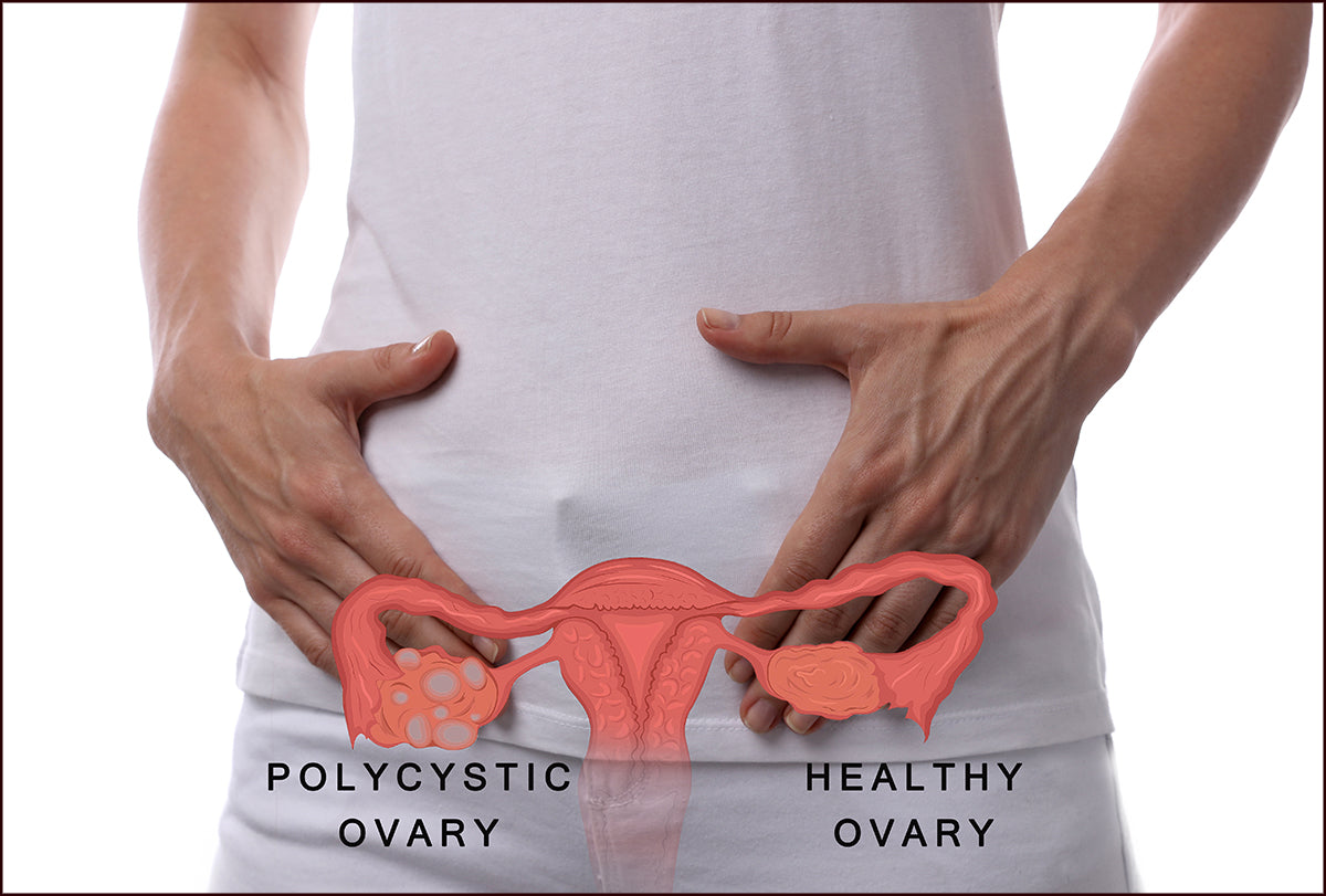 understanding pcos