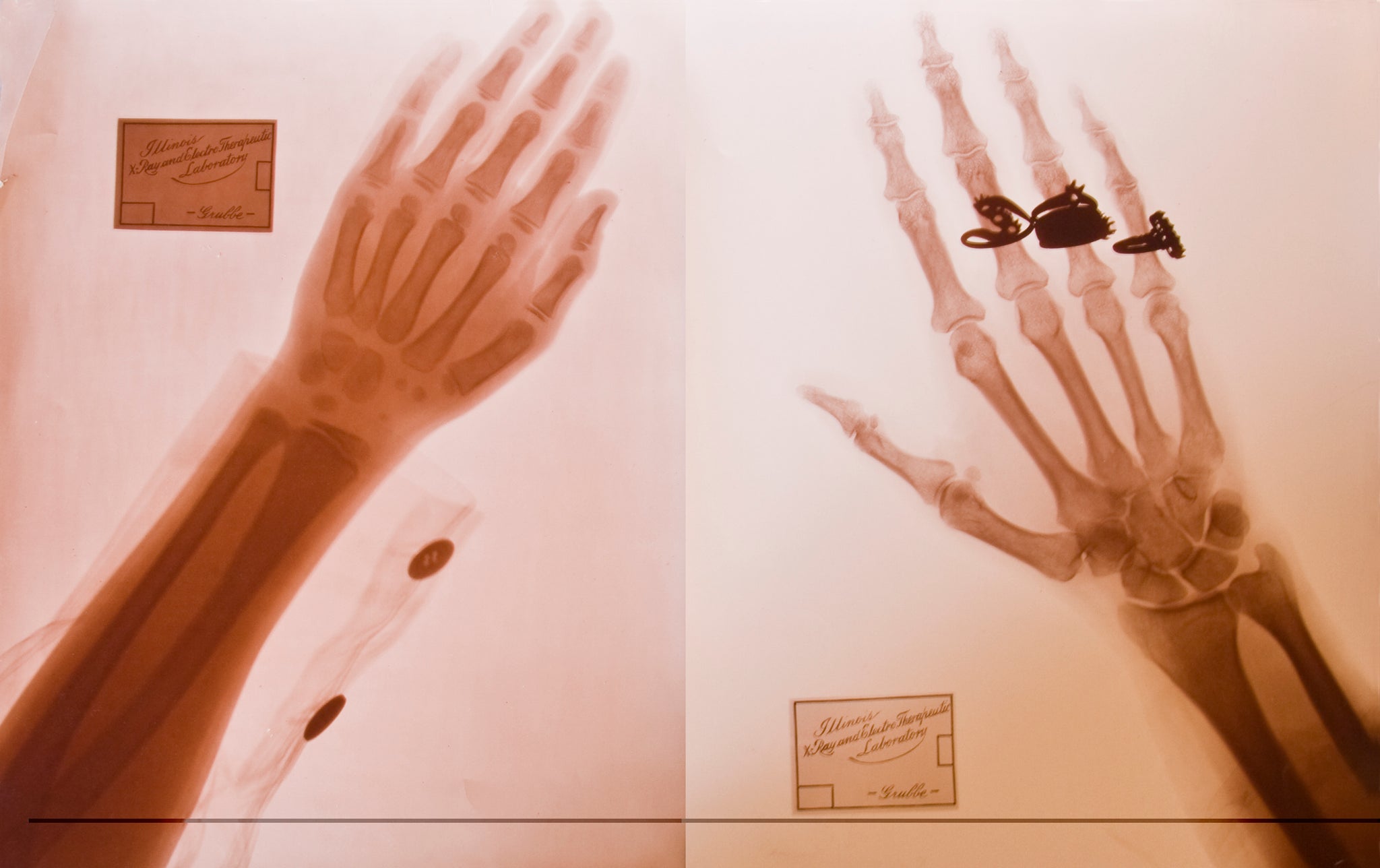 Original x-ray prints taken by Emil Grubbe, Chicago IL, c.1901. Collections of the International Museum of Surgical Science.