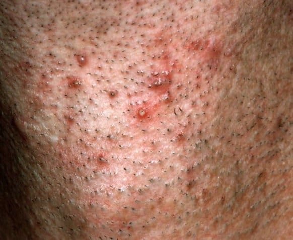 Ingrowth & Pseudofolliculitis