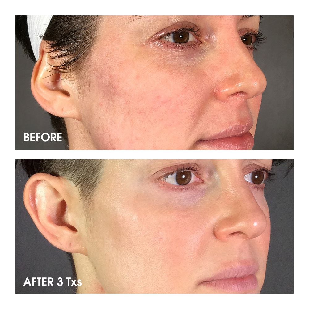 Microneedling Raleigh NC