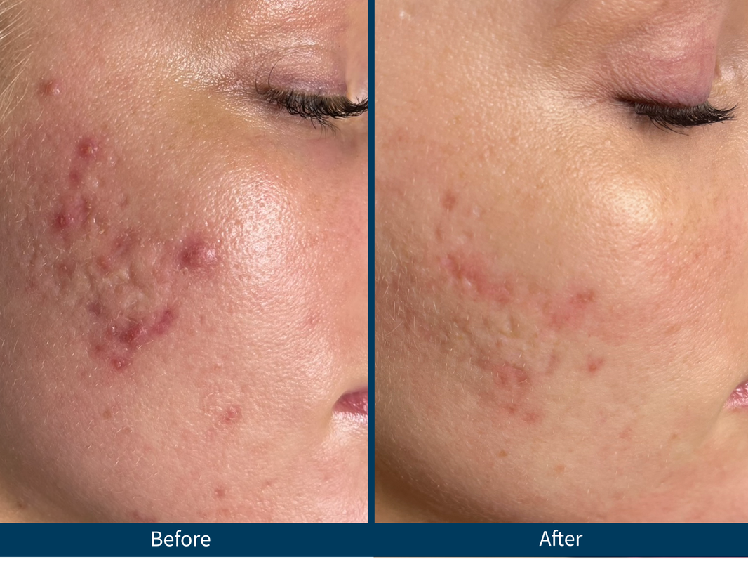 microneedling raleigh nc