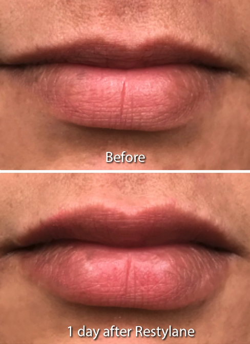 lip filler results in San Diego, CA