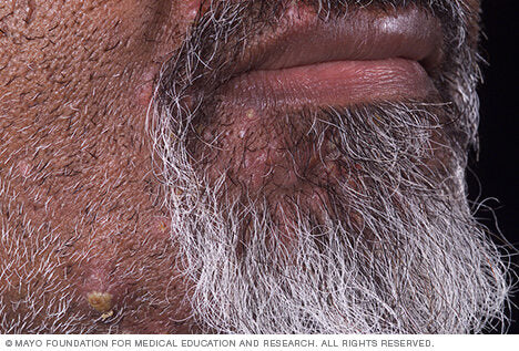 Razor bumps affect people with curly beards. The condition is also called pseudofolliculitis barbae. It develops when shaved hairs curve back into the skin, leading to inflammation.