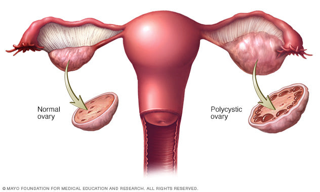 Polycystic ovary syndrome (PCOS)