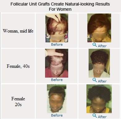 Follicular unit grafts create natural-looking results for women