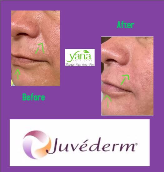 Juvederm & Voluma